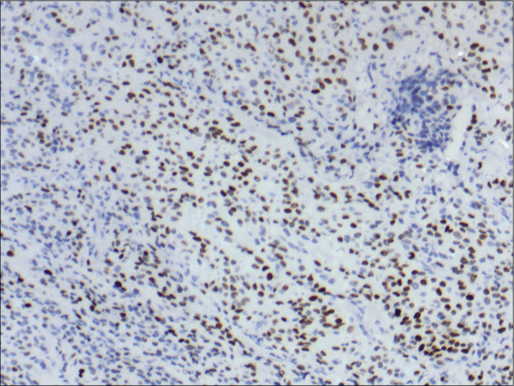 Special AT-rich sequence-binding protein 2 nuclear positivity in the tumor cells. Immunohistochemistry ×100.