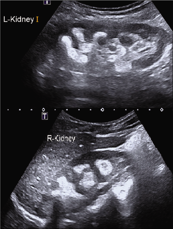 USG abdomen showing multiple bilateral renal calculi with evidence of nephrocalcinosis.