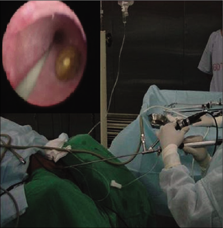 Ureterorenoscopy and lithoclast of ureteric stone.