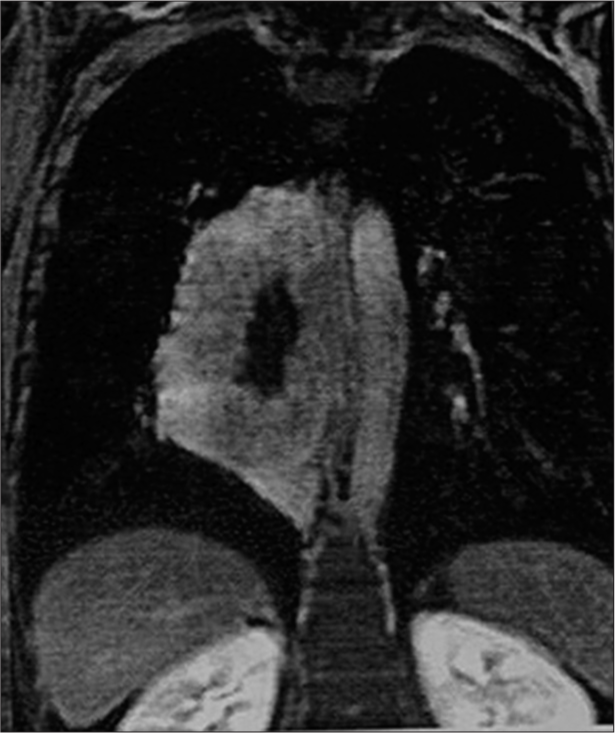 Mass showing a progressive centripetal enhancement with central non-enhancing area.