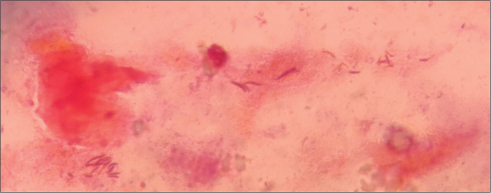 Gram stain of throat swab showing Gram-positive bacilli.