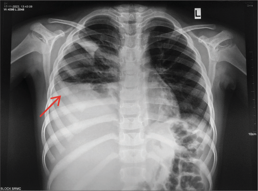 Chest X-ray showing right sided pleural effusion on day 6 of illness (day 3 of admission).