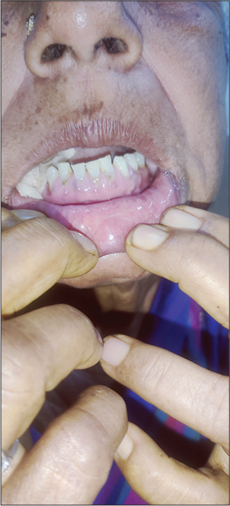 Gingival enlargement following chronic usage of amlodipine.