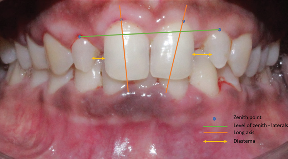 Pre-operative smile analysis.