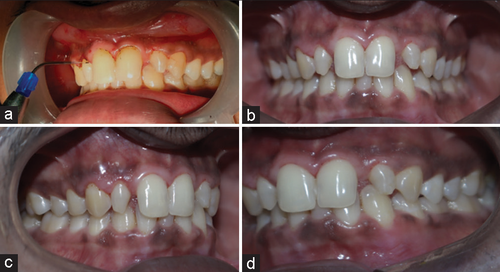 (a) Laser gingivoplasty and post gingivoplasty images – (b) end on, (c) right lateral, (d) left lateral views.