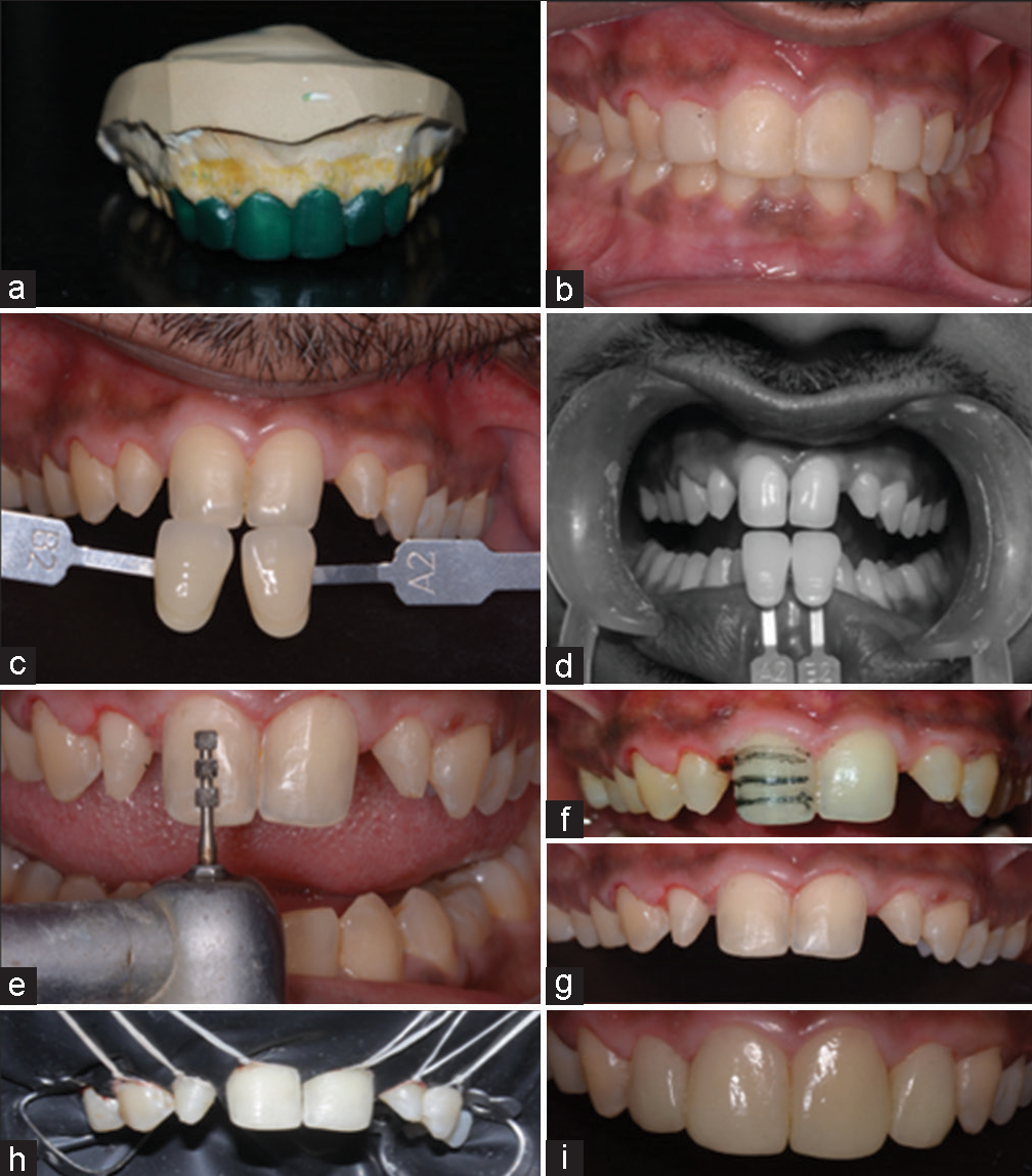 (a) Wax up of master cast and (b) mock up with bis acryl intra oral, (c and d) Shade matching in normal and monochromatic views, (e and f) depth marking for tooth preparation, (g) tooth preparation lateral and central incisors, (h) isolation of teeth with rubber dam, (i) post cementation.