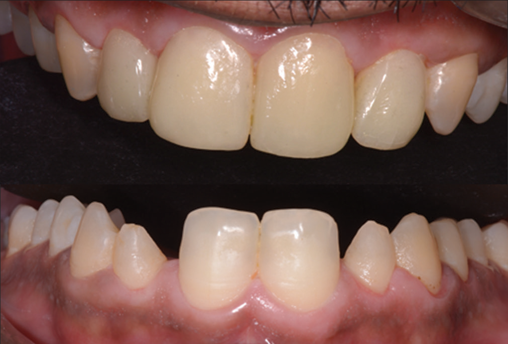 Post operative (above) compared to pre operative (below).