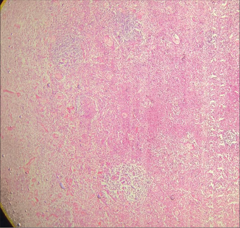 Low-power view shows confluent necrosis with partial preservation of the lymph node architecture in ×5 magnification.