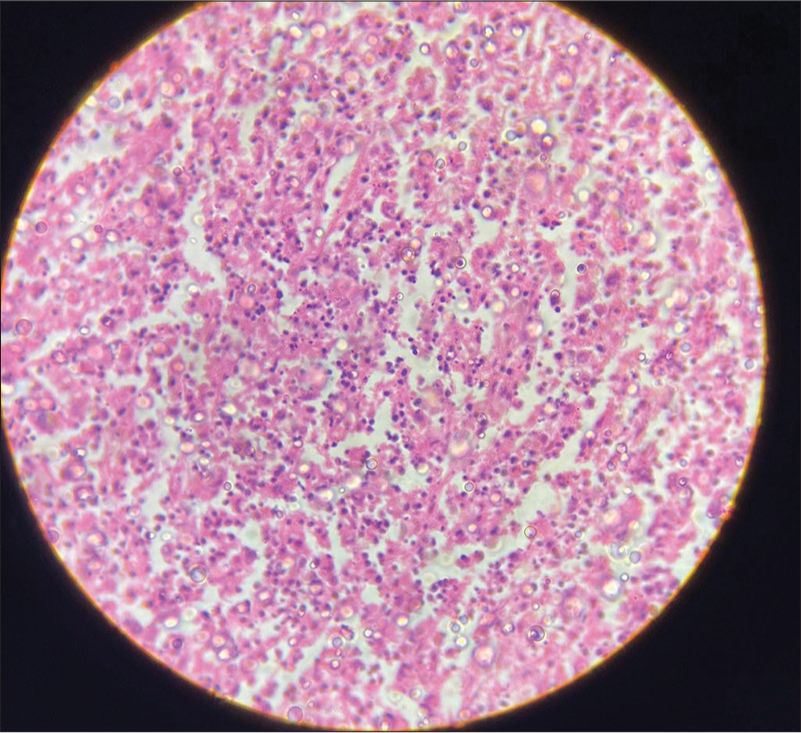 High-power view shows apoptotic cells with nuclear debris, as well as admixed histiocytes and transformed lymphocytes in ×40 magnification.