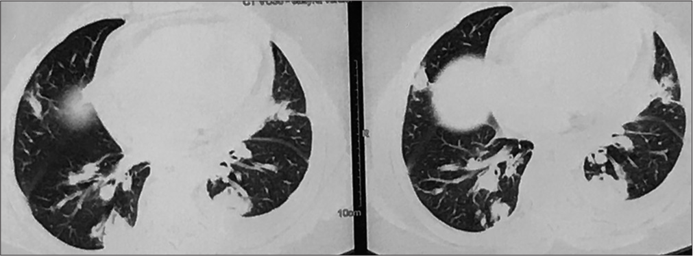 High-resolution computed tomography (HRCT) thorax showing bilateral, peripheral consolidation.