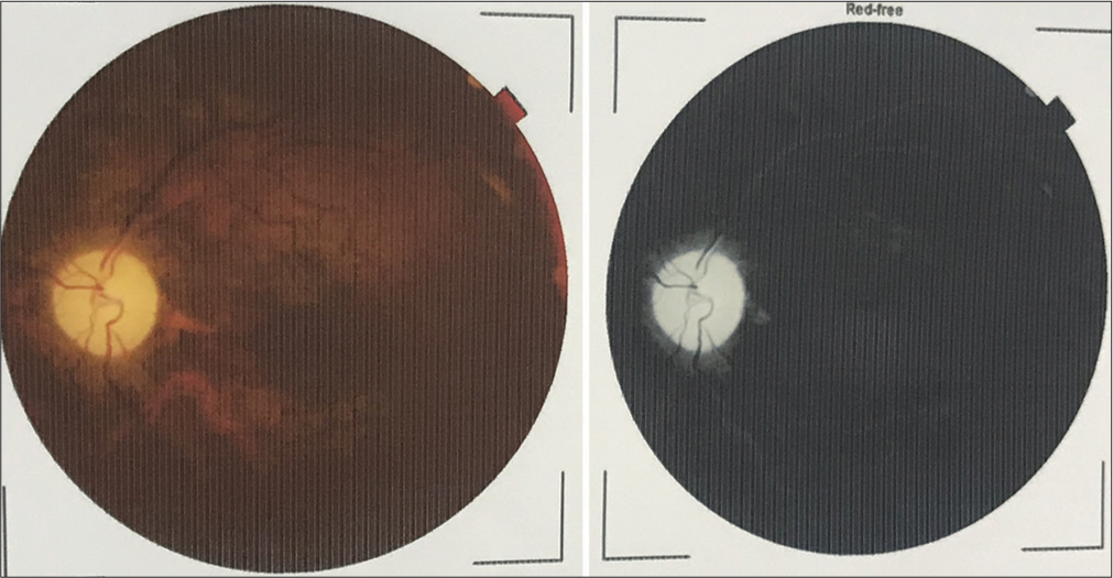 Fundoscopic examination showing papilledema with optic atrophy.