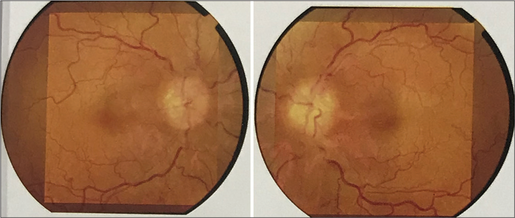 Fundus examination showing optic disc edema, optic cup full, and pallor present with gross vascular attenuation.
