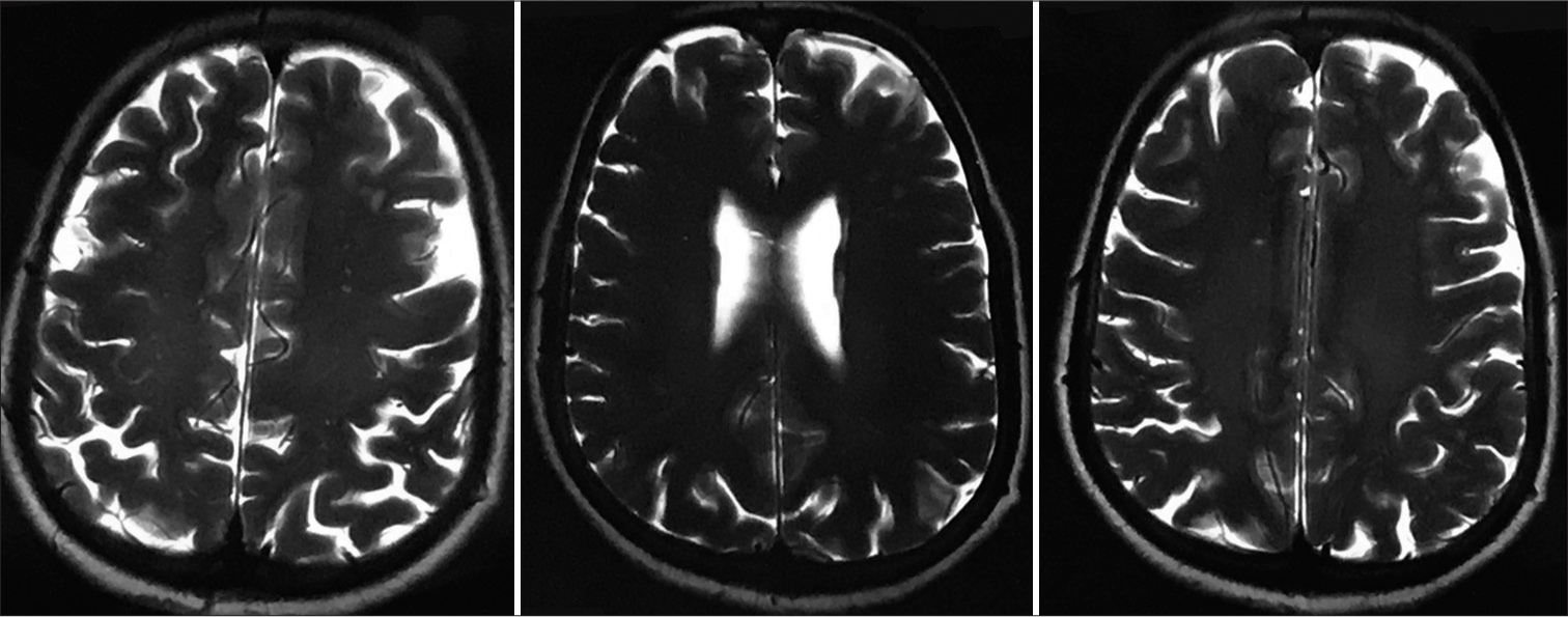 Magnetic resonance imaging brain imaging showing subacute non-hemorrhagic infarct right occipital lobe and deep microvascular ischemic changes.