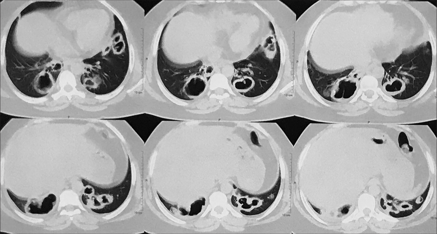 High-resolution computed tomography (HRCT) thorax bilateral peripheral, pleural-based thick-walled, irregular, variegated, and bizarre-shaped cavities with intracavitary opacities.