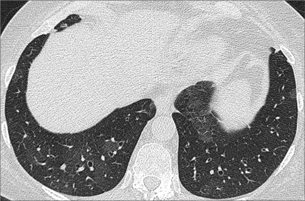 High-resolution computed tomography (HRCT) thorax normal lung parenchyma with resolution of lung parenchymal abnormalities.