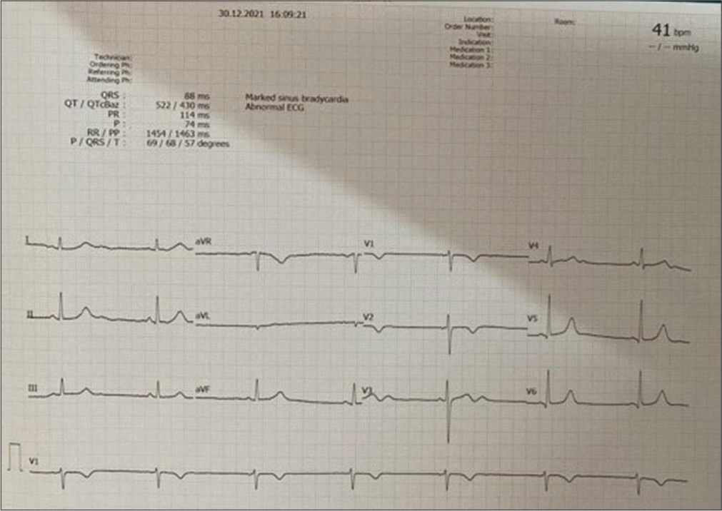 Electrocardiography showed sinus bradycardia.