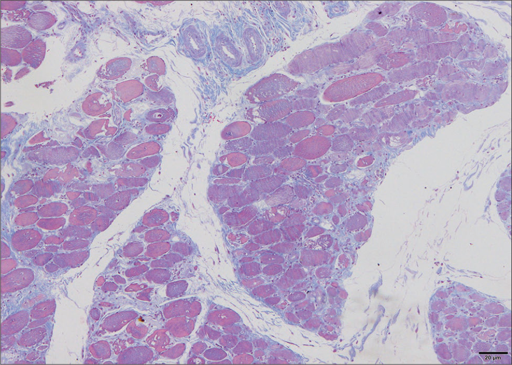 Muscle biopsy with H&E cryosections. H&E: Haematoxylin and eosin stain.