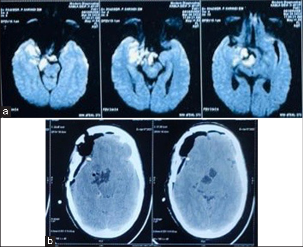 (a) On the diffusion-weighted image, the parasellar region shows a high-intensity signal. (b) Post-operative computed tomography brain.