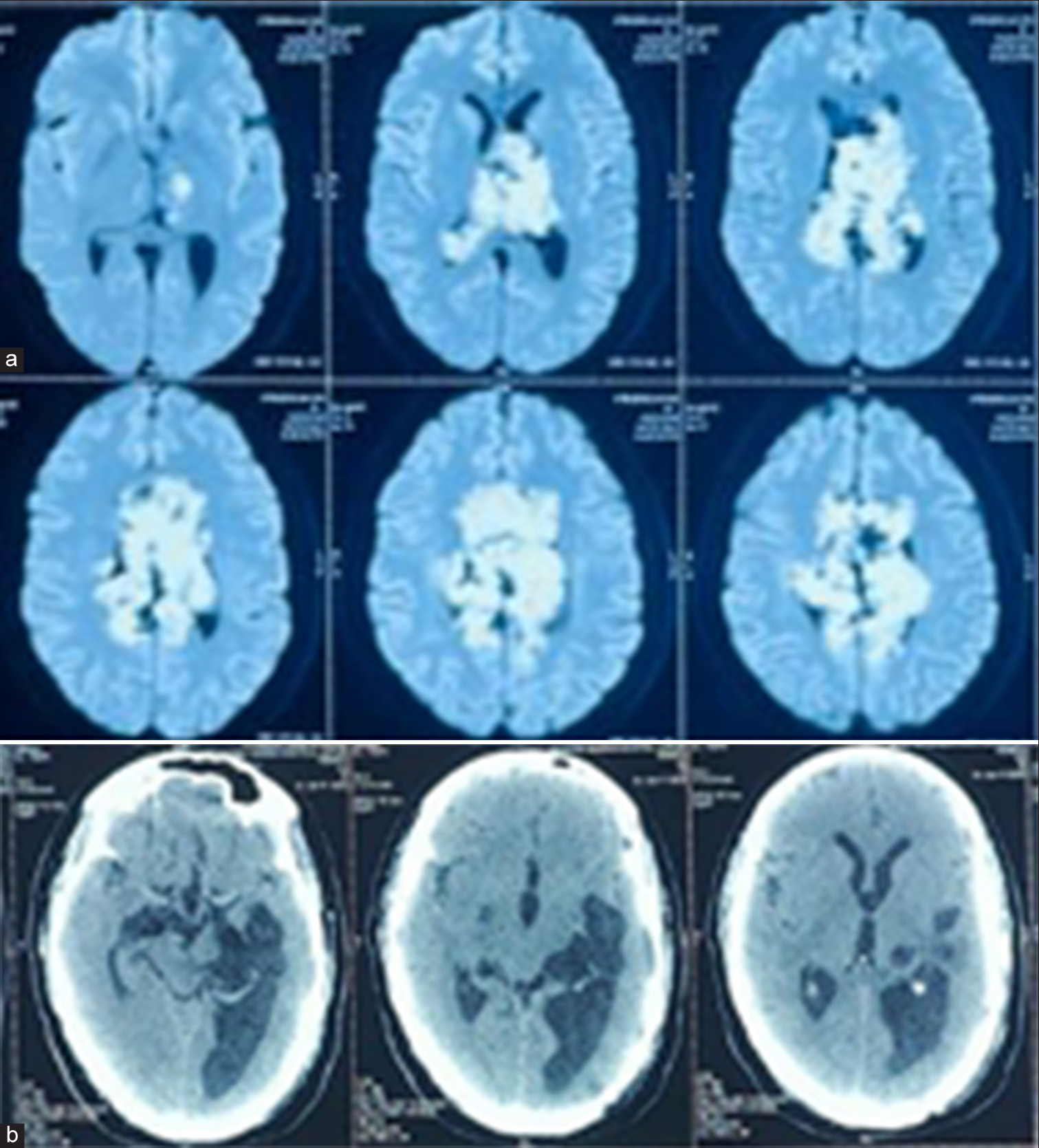 (a) On the diffusion-weighted image, the interhemispheric area shows a high-intensity signal. (b) Post-operative computed tomography brain.