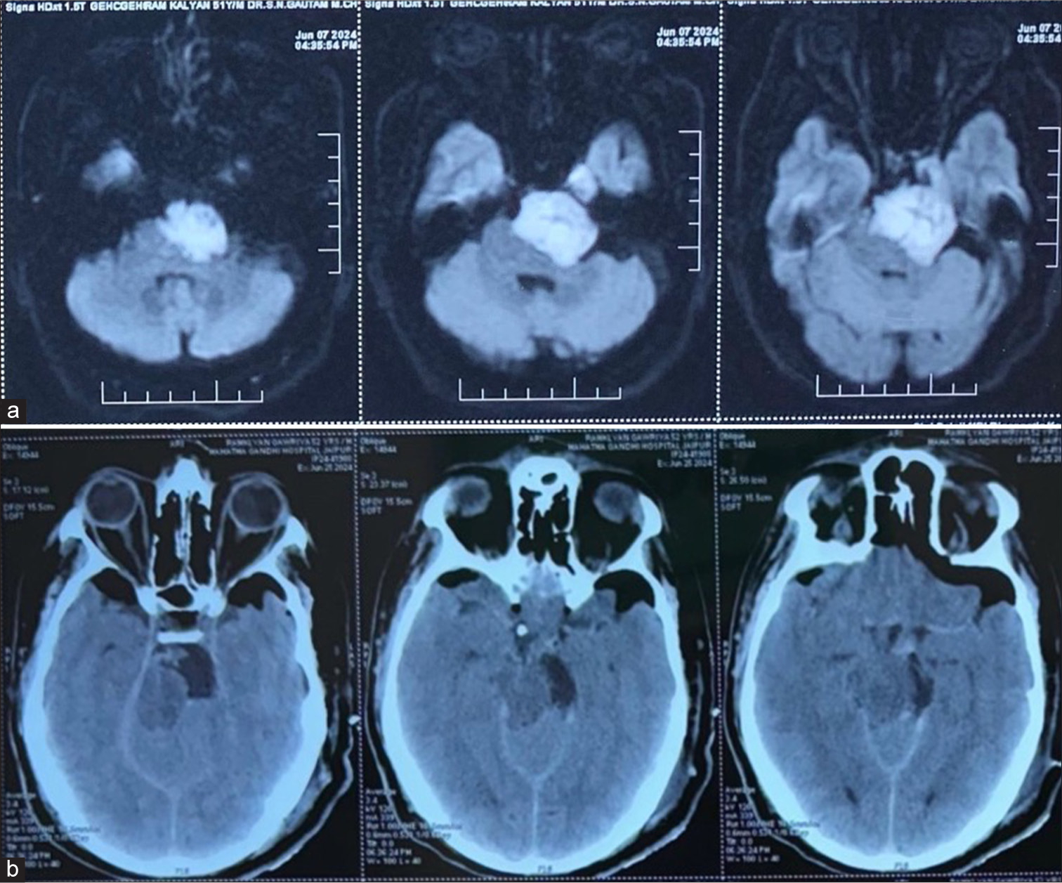 (a) Diffusion-weighted pre-operative brain magnetic resonance imaging revealed a diffusion restriction in the left cerebellopontine angle. (b) Post-operative computed tomography brain.