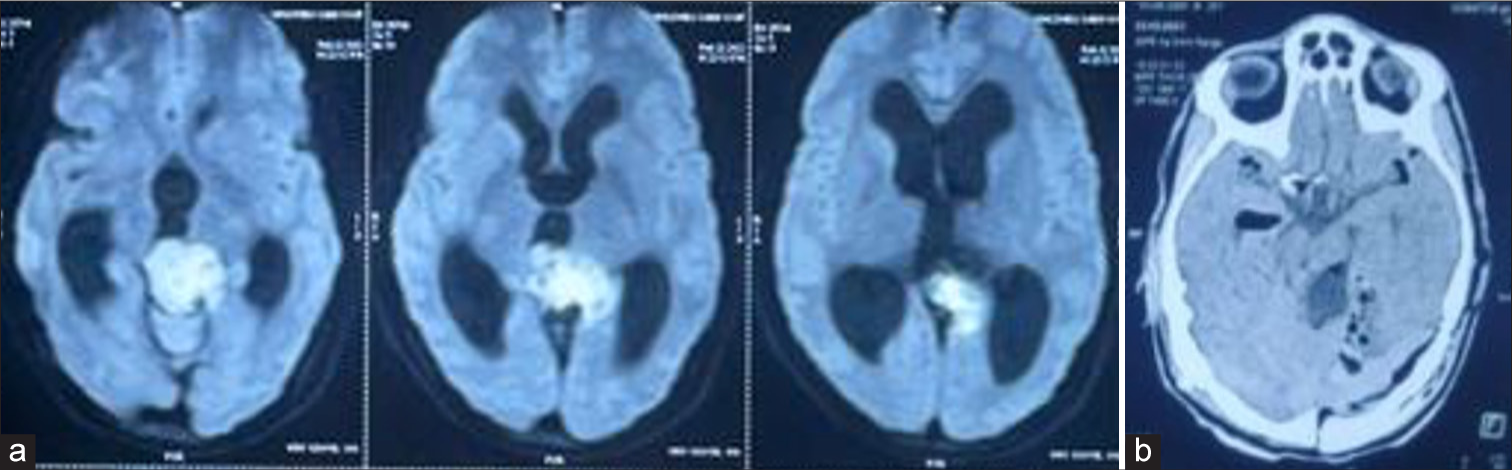 (a) On the diffusion-weighted image, the pineal region shows a high-intensity signal. (b) Post-operative computed tomography brain.