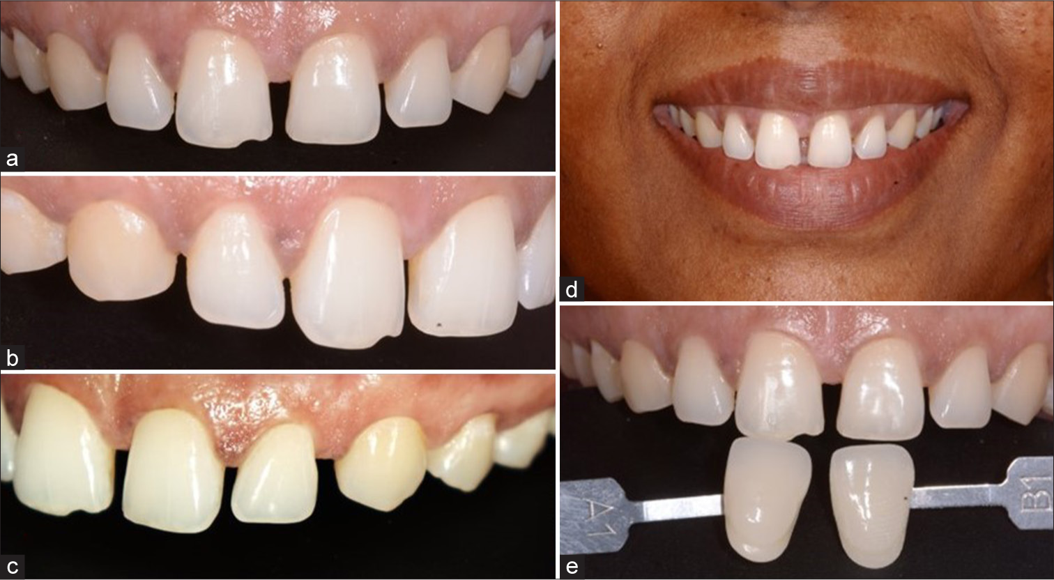 Pre-operative (a) frontal view, (b) right lateral view, (c) left lateral view, (d) smile line evaluation, and (e) shade evaluation.