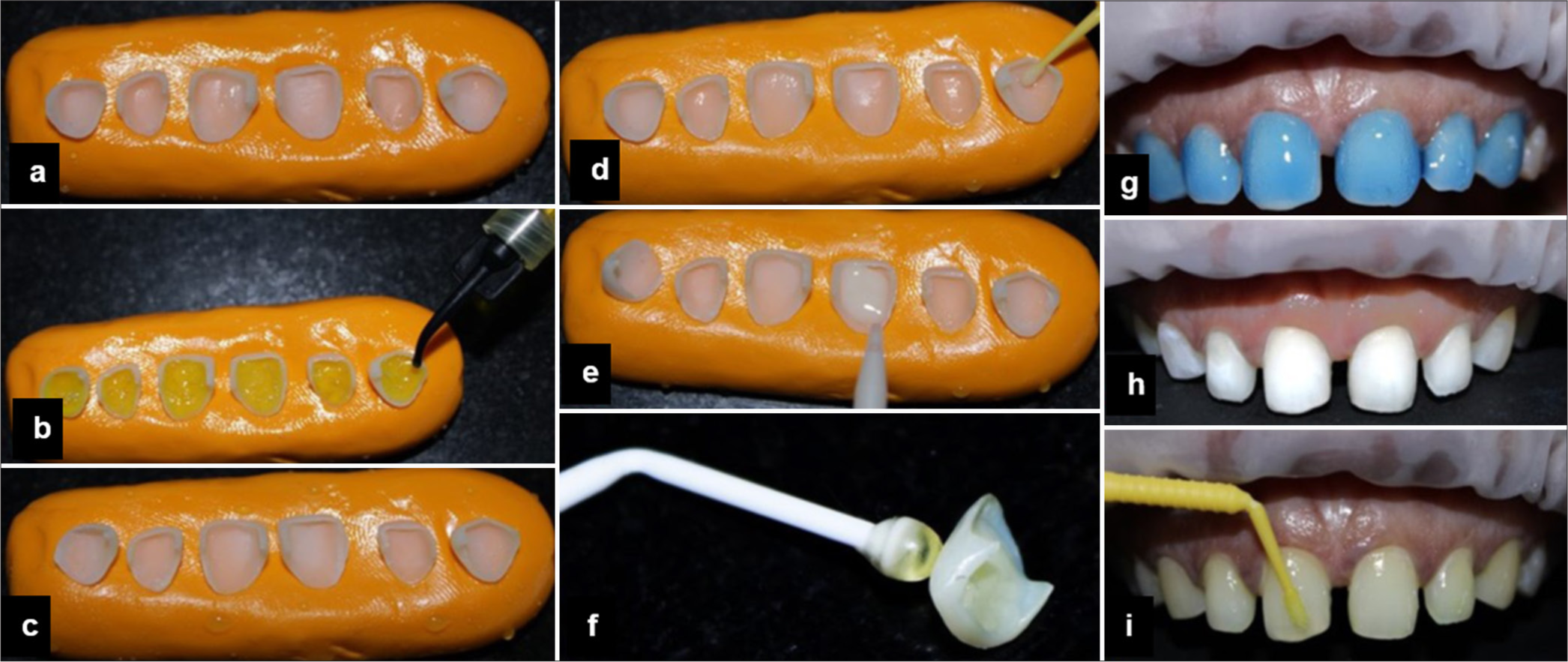 (a) Veneers stabilized in elastomeric impression material, (b) veneers etched with 9% hydrofluoric acid, (c) etched veneer surface, (d) silanizing the veneers, (e) resin applied onto the veneer, (f) veneers carried using sticky applicator tip, (g) teeth etched with 37% phosphoric acid, (h) etched teeth, and (i) bonding agent applied onto the teeth.