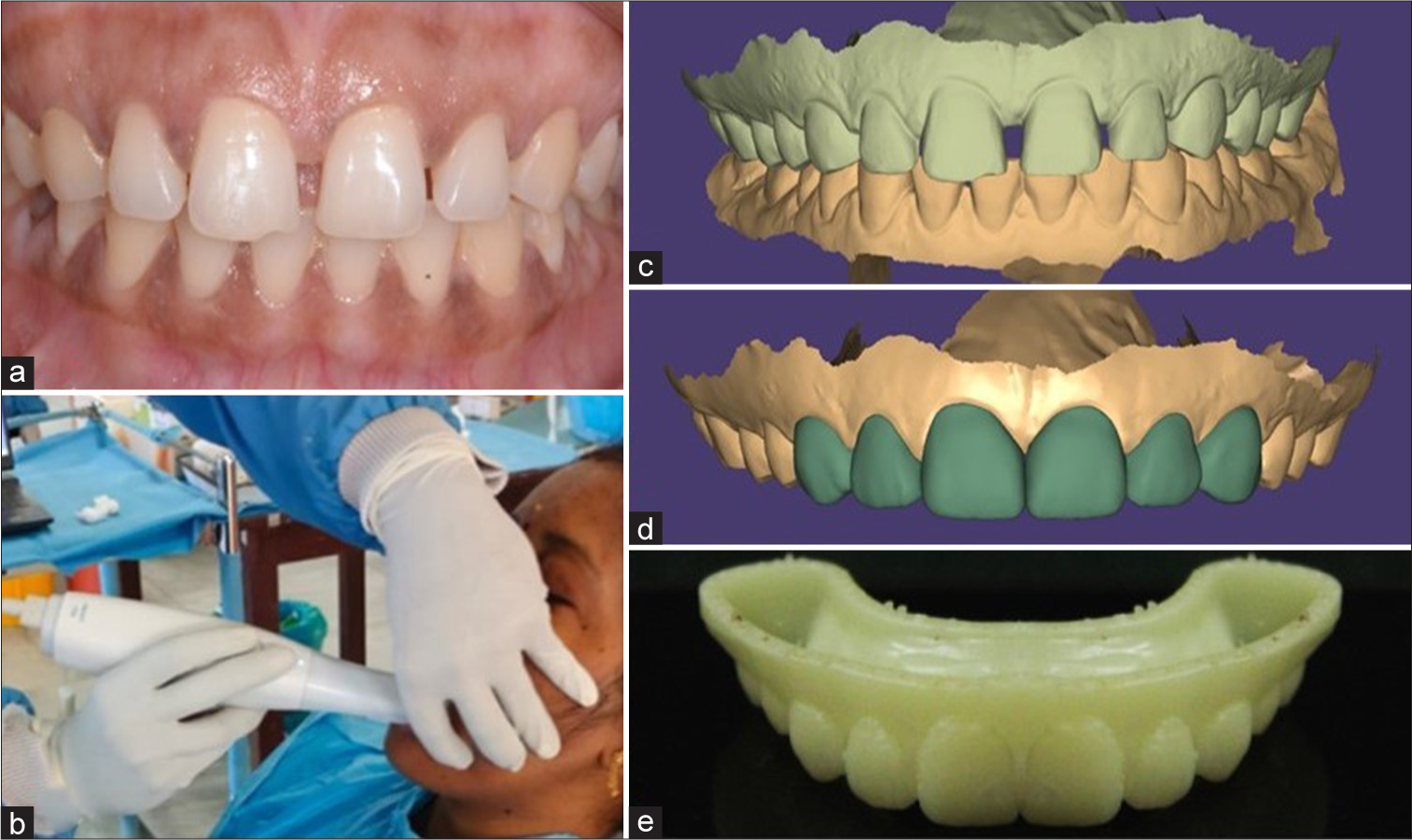 (a) Pre-operative occlusion evaluation, (b) intra-oral scanning, (c) scanned data, (d) digital smile designing, and (e) 3D printed mock-up.