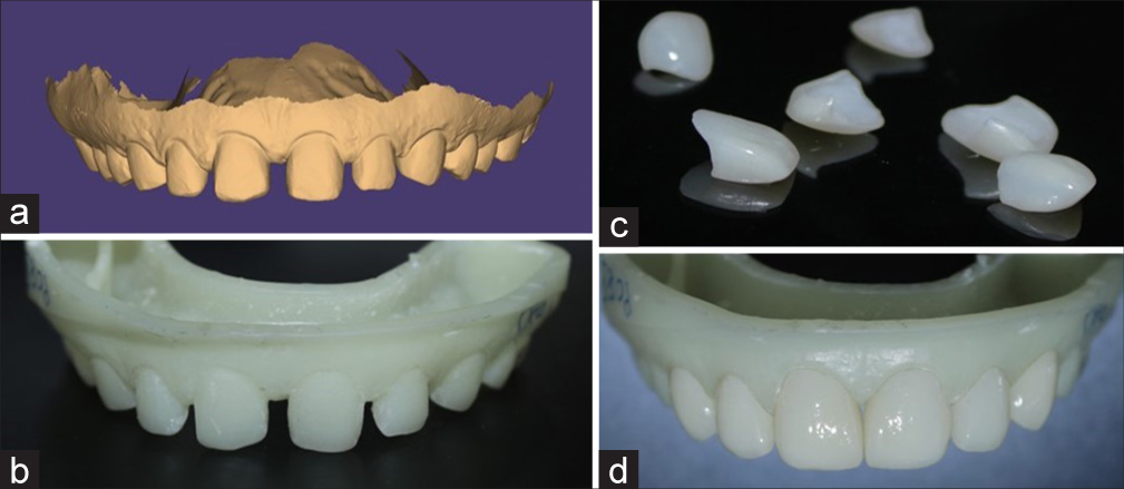 (a) Digital scan of tooth preparation for veneer, (b) 3D printed cast, (c) fabricated veneers, and (d) veneers in 3D printed cast evaluating the fit.