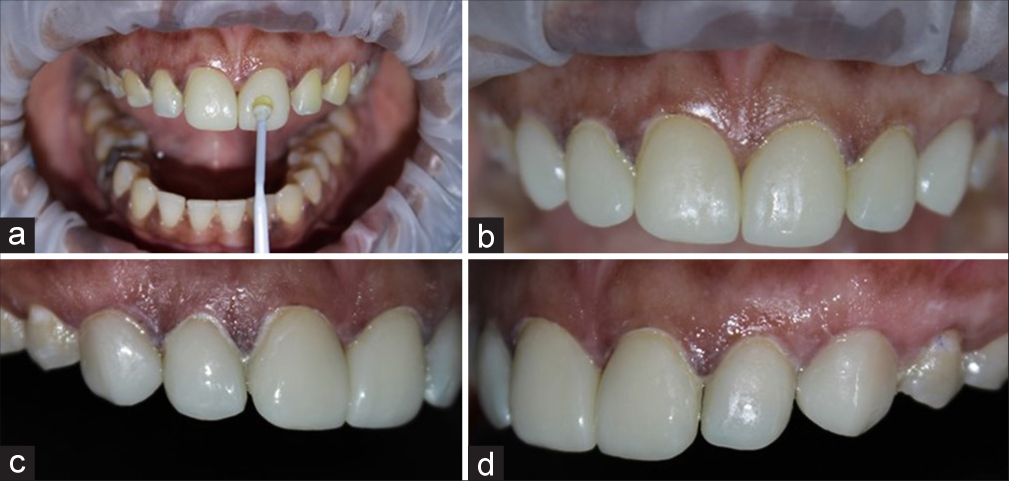 (a) Veneers transferred to the teeth using sticky applicator tip, post-operative (b) frontal view, (c) right lateral view, and (d) left lateral view.