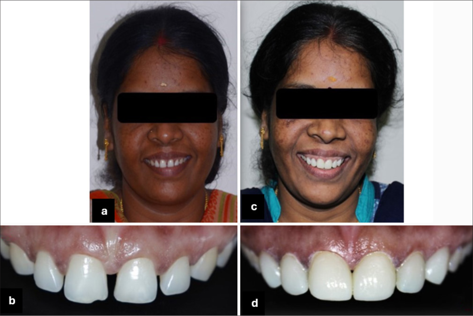 Pre-operative (a) face, (b) teeth, post-operative (c) face , and (d) teeth.